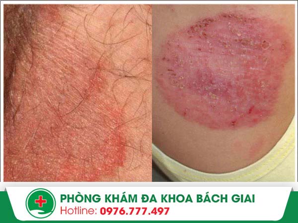 Nấm háng là bệnh gì? Phương pháp nào điều trị hiệu quả tình trạng này?