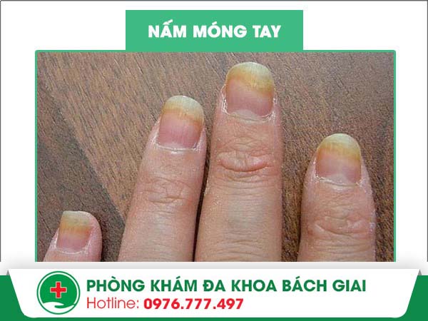 Nấm móng tay là bệnh như thế nào?