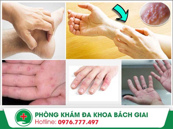 Ngứa tay chân – Cảnh báo một số bệnh nguy hiểm