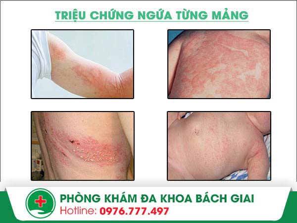 Ngứa từng mảng là triệu chứng của bệnh gì?