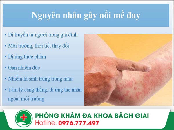 Nguyên nhân nổi mề đay và cách điều trị hiệu quả