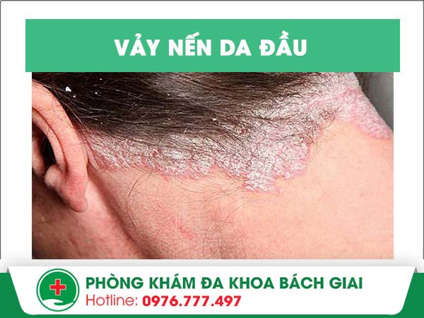 Nguyên nhân gây ra vảy nến da đầu