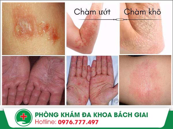 Nhận diện triệu chứng bệnh chàm thông qua những dấu hiệu nào?