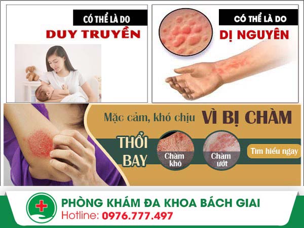 Nguyên nhân nào gây nên bệnh chàm bạn đã biết?