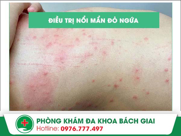 Nổi mẩn đỏ ngứa – Phương pháp nào điều trị hiểu quả nhanh chóng nhất?