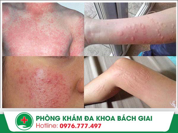 Da bị dị ứng làm gì để tránh thâm sẹo?