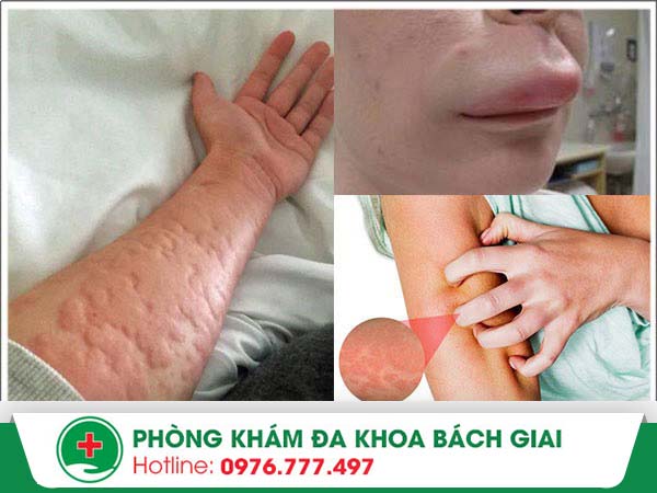 “Cảnh báo” về căn bệnh phong lạnh nổi mề đay cực nguy hiểm