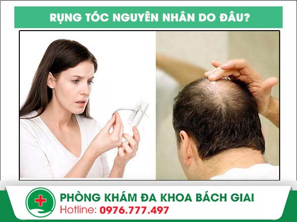 Bệnh rụng tóc – Mối lo lắng không của riêng ai