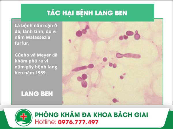 Những tác hại khôn lường của bệnh lang ben – Bạn đã biết