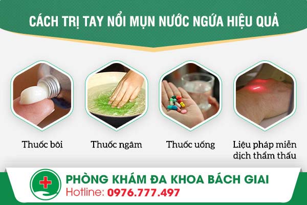 Tay nổi mụn nước ngứa – Mách bạn cách điều trị hiệu quả