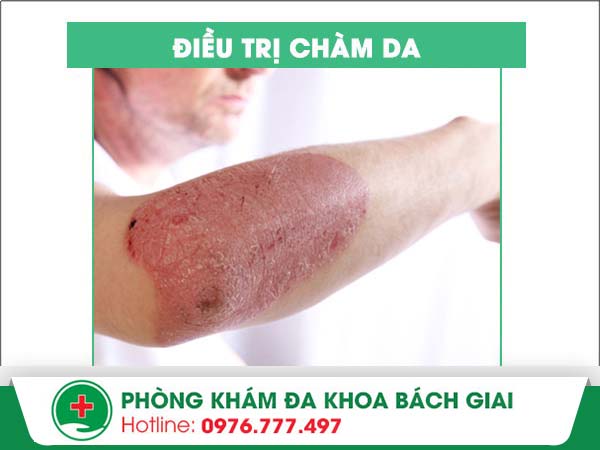 Nên điều trị chàm da bằng phương pháp nào giúp hiệu quả tối ưu?