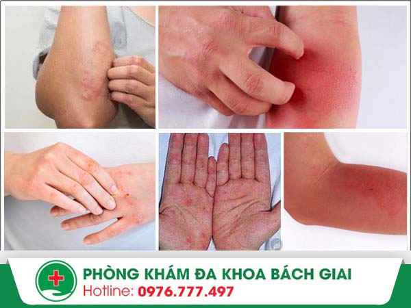 Bị chàm tay nên điều trị bằng phương pháp nào hiệu quả?