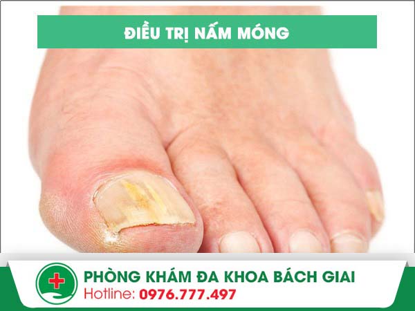 Điều trị nấm móng bằng phương pháp nào hiệu quả?