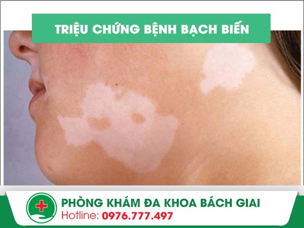 Các triệu chứng thường gặp ở bệnh bạch biến