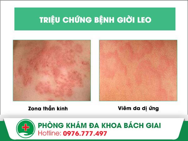 Triệu chứng bệnh giời leo bạn đã biết?