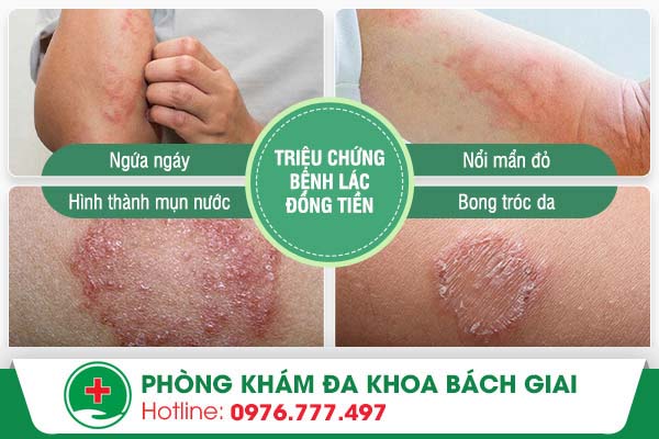 Triệu chứng của bệnh lác đồng tiền và phương pháp nào điều trị hiệu quả