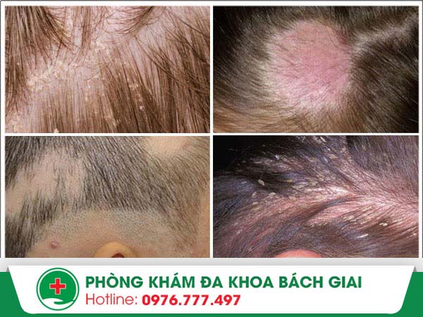 Triệu chứng bệnh nấm tóc – Bạn đã biết!