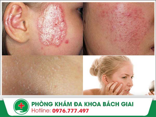 Triệu chứng ngứa mặt “cảnh báo” vấn đề gì?