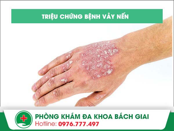 Triệu chứng của bệnh vảy nến giúp bạn sớm nhận biết