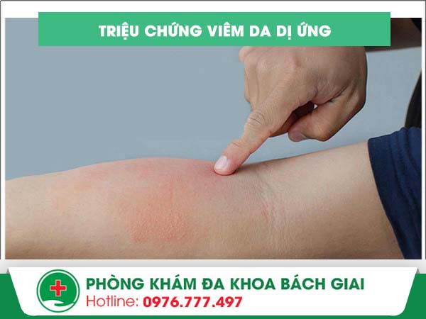 Nhận biết triệu chứng viêm da dị ứng