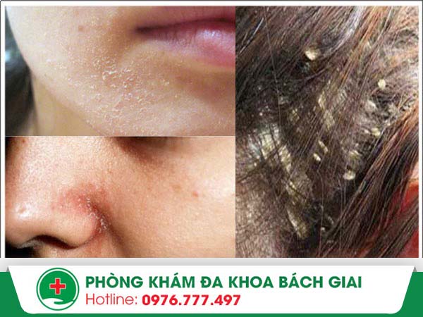 Triệu chứng viêm da tiết bã và phương pháp điều trị