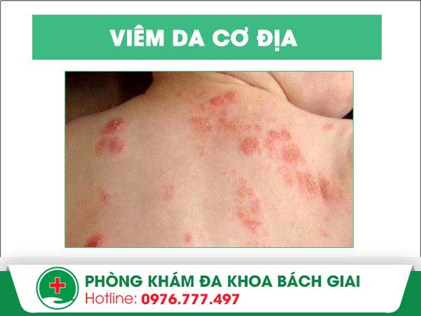 “Cảnh giác” với bệnh viêm da cơ địa