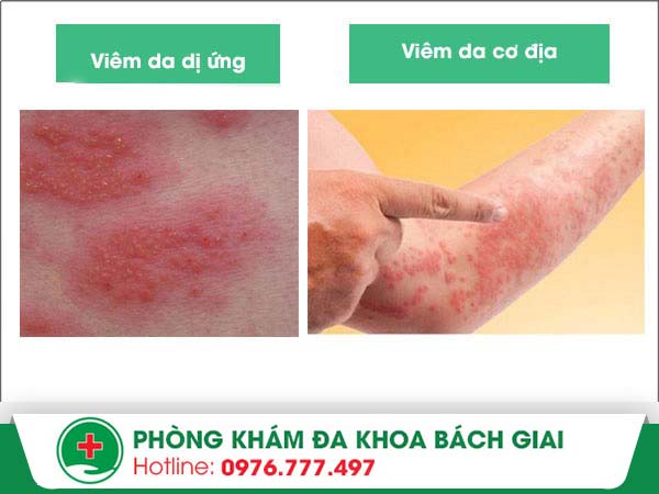 Phân biệt giữa viêm da cơ địa và viêm da dị ứng