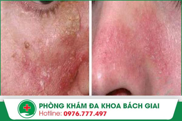 Cần “cảnh giác” với bệnh viêm da nhờn