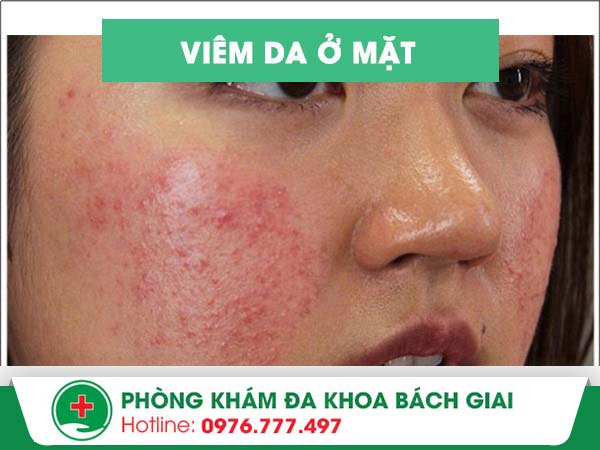 Nguyên nhân nào dẫn tới tình trạng viêm da mặt?