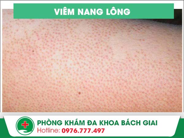 Nguyên nhân gây ra tình trạng viêm nang lông