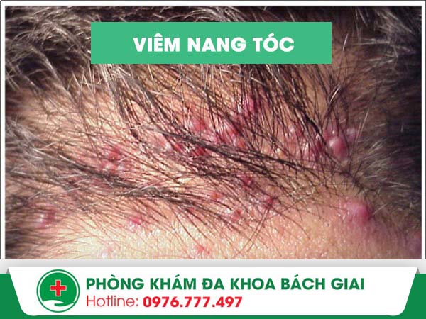 Nguyên nhân nào dẫn tới tình trạng viêm nang tóc và cách điều trị