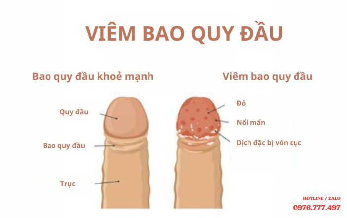 Bị ngứa vùng kín nam: Phương pháp nào chữa hiệu quả?